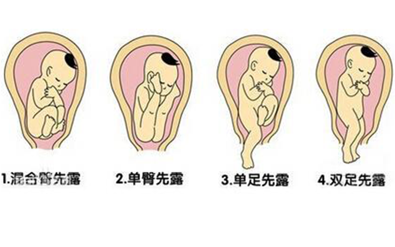 七个月臀位图片七个月臀位图片，了解胎儿体位与孕期健康